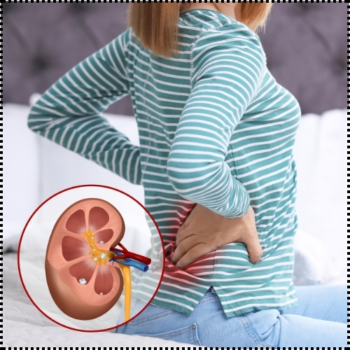 Prevent Kidney Stones - Healix Stones