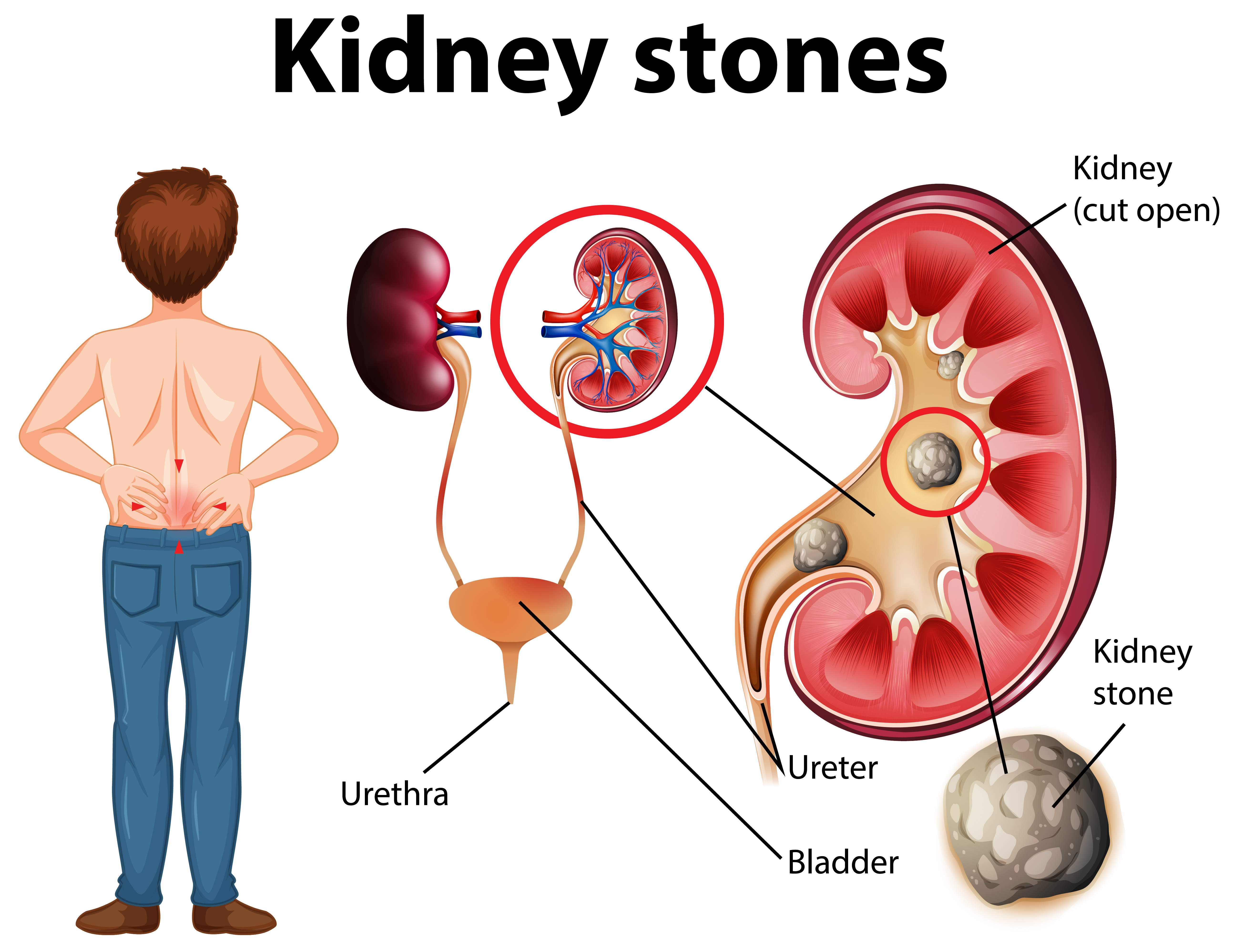 Understanding Urology - Kidney Stones - Healix Hospitals